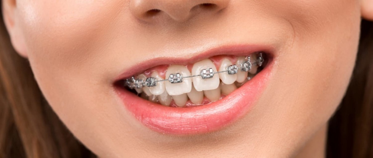 Diş Telinde Kullanılan Diş Teli Çeşitleri Nelerdir?