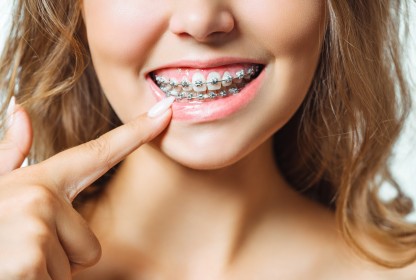 Şeffaf-Metal Braketli Ortodontik Tedavi (Tel Tedavisi)